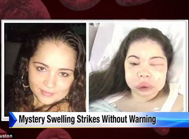 Bí hiểm căn bệnh đột biến gen khiến cơ thể người to gấp đôi ảnh 1