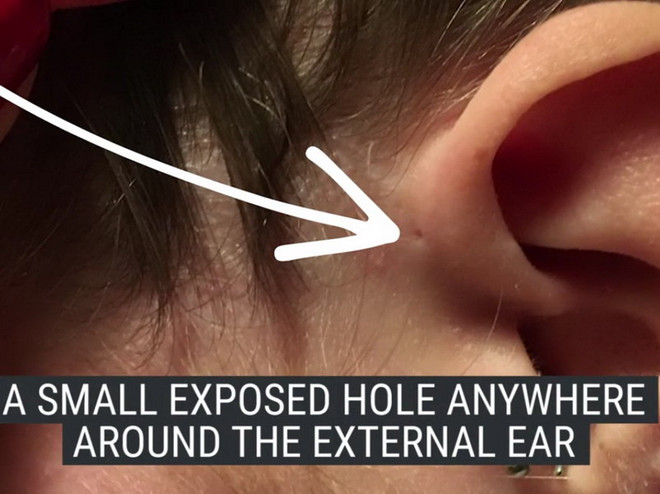 Tại sao một số người khi sinh ra đã có một lỗ nhỏ trên tai? ảnh 1