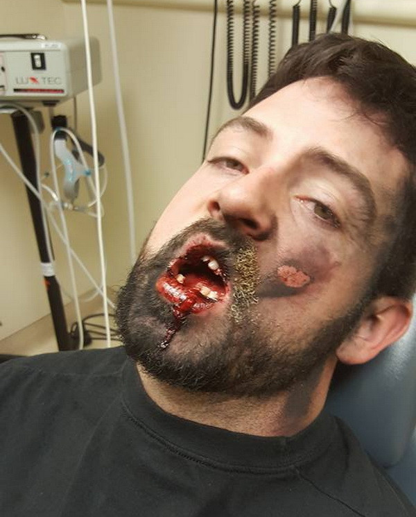 Mất 7 chiếc răng vì thuốc lá điện tử bất ngờ phát nổ trên miệng ảnh 2