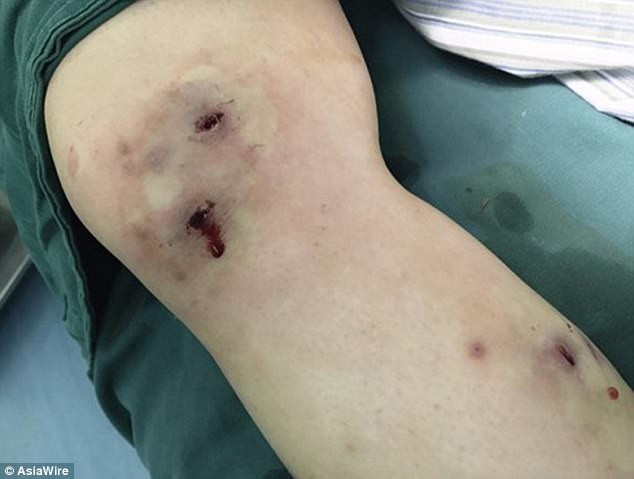 Cô gái kinh hãi khi chứng kiến con giòi chui ra từ chân mình ảnh 2