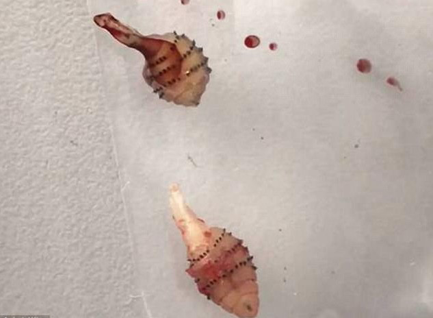 Cô gái kinh hãi khi chứng kiến con giòi chui ra từ chân mình ảnh 1