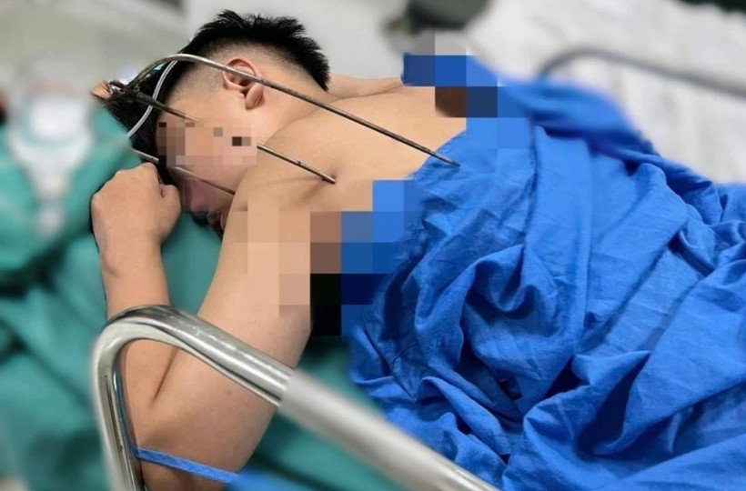 Nam thanh niên nhập viện trong tình trạng dị vật kim loại sắc nhọn, dạng đinh ba tự chế đâm từ phía sau vai trái, xuyên sâu vào lồng ngực (Ảnh: Bệnh viện cung cấp).
