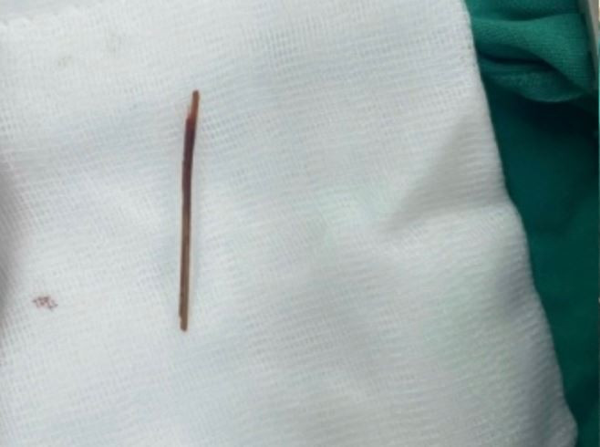 Chiếc tăm tre đâm xuyên dạ dày được lấy ra. (Nguồn: Báo Lao động)