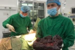 Khối u lá lách khủng được lấy trọn vẹn ra khỏi cơ thể bệnh nhân. (Ảnh: TTXVN phát)