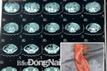 Phim chụp cắt lớp vi tính ổ bụng của bệnh nhân và đoạn ruột chứa polyp được các bác sỹ phẫu thuật cắt bỏ. (Nguồn: Báo Đồng Nai)