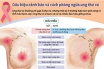 [Infographics] Dấu hiệu cảnh báo và cách phòng ngừa ung thư vú