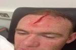 Lộ ảnh chấn thương kinh hoàng của Wayne Rooney