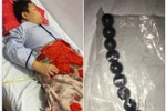 Một bệnh nhi bị hoại tử ruột do nuốt 9 viên bi nam châm