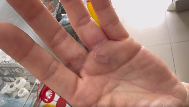 Hình ảnh bàn tay có giun làm ổ dưới da do nhiễm giun chó mèo. (Ảnh: Bệnh viện cung cấp)