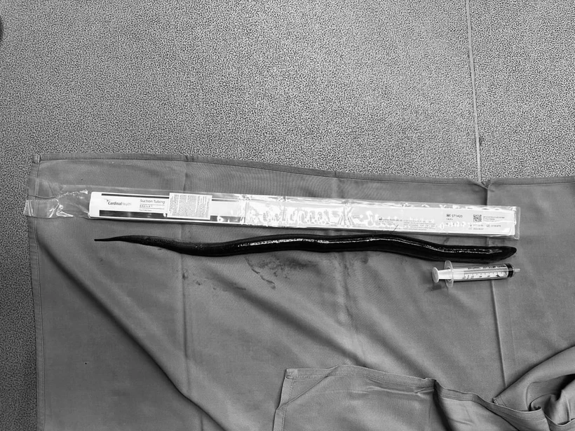 Con lươn dài 30cm được lấy ra khỏi ổ bụng của bệnh nhân. (Ảnh: TTXVN phát)