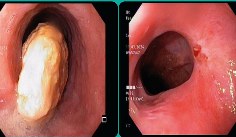 Khối dị vật chiếm gần hết lòng thực quản và lòng thực quản sau khi dị vật đã được lấy ra. (Ảnh: TTXVN phát)