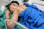 Nam thanh niên nhập viện trong tình trạng dị vật kim loại sắc nhọn, dạng đinh ba tự chế đâm từ phía sau vai trái, xuyên sâu vào lồng ngực (Ảnh: Bệnh viện cung cấp).