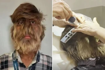 Lalit Patidar mắc phải hội chứng bệnh hiếm gặp có tên gọi là “chứng rậm lông”. (Nguồn: The Sun)