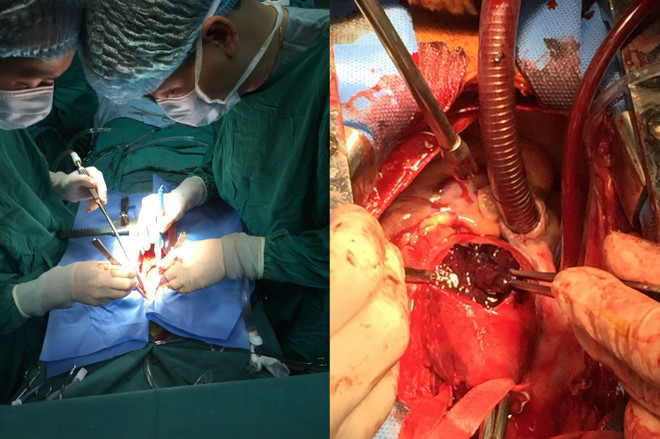 Phẫu thuật cứu sống bệnh nhân phình động mạch, biến chứng nguy kịch ảnh 1