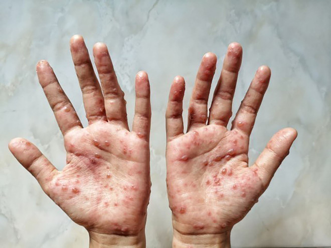 Các ban đỏ nổi trên tay một bệnh nhân mắc bệnh đậu mùa khỉ. (Ảnh: Shutterstock/TTXVN) Israel chuẩn bị triển khai tiêm vaccine ngừa đậu mùa khỉ ảnh 1