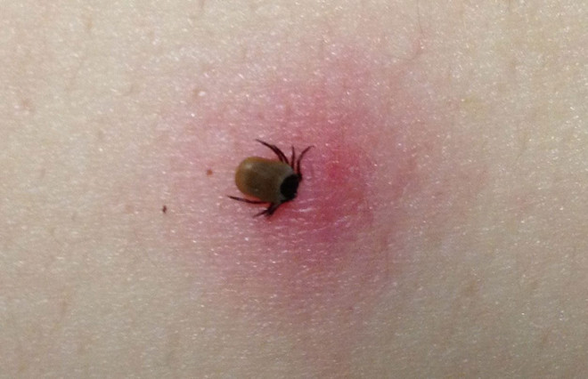 Hơn 14% dân số thế giới mắc bệnh Lyme do bọ chét cắn gây ra ảnh 1