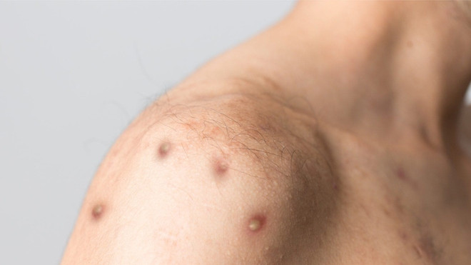 Đan Mạch ghi nhận ca mắc đậu mùa khỉ đầu tiên ở phụ nữ ảnh 1