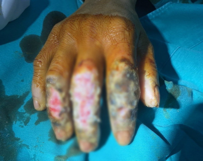 Cảnh báo tình trạng tự ý đắp thuốc nam chữa bỏng tại nhà ảnh 1