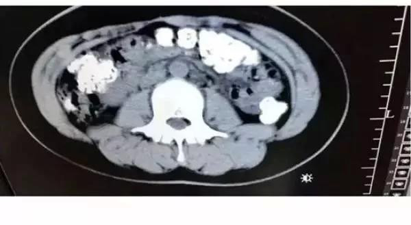 Phát hiện hàng trăm hạt trân châu chưa tiêu hóa trong bụng một cô bé ảnh 1