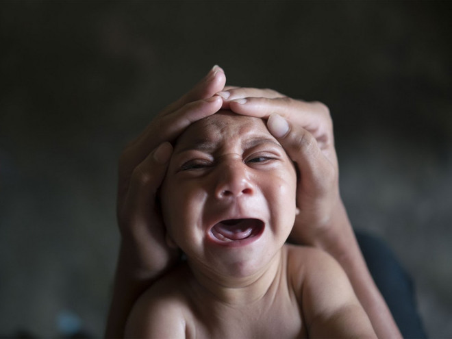 Số trẻ sơ sinh bị dị tật đầu nhỏ tại Brazil tiếp tục tăng ảnh 1