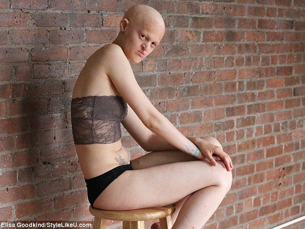 Người mẫu bị dị tật bẩm sinh cởi đồ nhằm phản đối kỳ thị ảnh 1