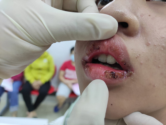 Làm đẹp bằng son giá rẻ không rõ nguồn gốc, môi thiếu nữ sưng tấy mủ ảnh 1