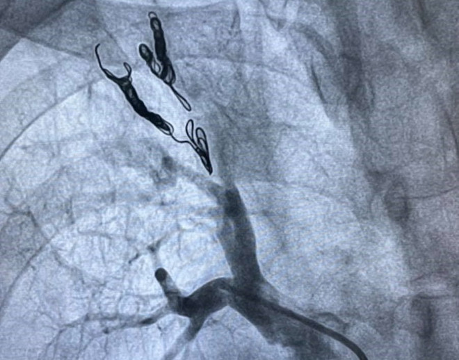 Bệnh viện TW Huế cứu sống bệnh nhân lao phổi ho ra máu, dễ tử vong ảnh 2