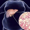 Béo phì, thừa cân là nguyên nhân chính gây gan nhiễm mỡ. (Ảnh: oxfordgutandliver)