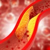Hình minh họa mỡ cholesterol xấu (LDL-C) lắng đọng thành từng mảng bám trên thành mạch máu, gây hẹp lòng mạch, cản trở lưu thông máu. (Ảnh: iStock)