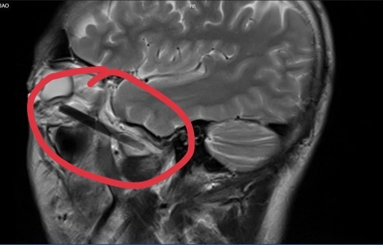 Hình ảnh dị vật trong mắt người đàn ông ở tỉnh Bình Dương. (Ảnh: TTXVN phát)