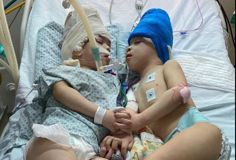 Viện Não bang Paulo Niemeyer (IECPN) ở thành phố Rio de Janeiro của Brazil đã thực hiện thành công ca phẫu thuật tách rời cặp song sinh Arthur (phải) và Bernardo Lima (trái) có hộp sọ và mạch máu não nối liền nhau, dưới sự trợ giúp của công nghệ thực tế ảo (VR). Ca đại phẫu được các bác sĩ mô tả là phức tạp nhất trong các loại hình phẫu thuật. (Ảnh: AFP/TTXVN)