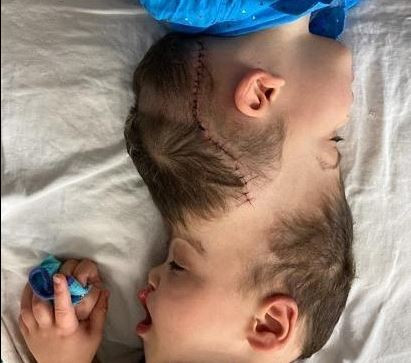 Viện Não bang Paulo Niemeyer (IECPN) ở thành phố Rio de Janeiro của Brazil đã thực hiện thành công ca phẫu thuật tách rời cặp song sinh Arthur (phải) và Bernardo Lima (trái) có hộp sọ và mạch máu não nối liền nhau, dưới sự trợ giúp của công nghệ thực tế ảo (VR). Ca đại phẫu được các bác sĩ mô tả là phức tạp nhất trong các loại hình phẫu thuật. (Ảnh: AFP/TTXVN)