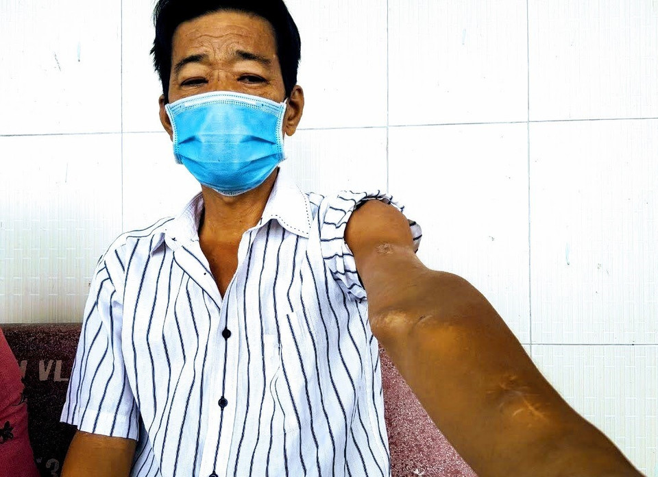 Anh Hồ Văn Sang (huyện Trà Ôn, tỉnh Vĩnh Long) và cánh tay đầy vết sẹo của kim tiêm sau 14 năm chạy thận. (Ảnh: Thanh Liêm/TTXVN)