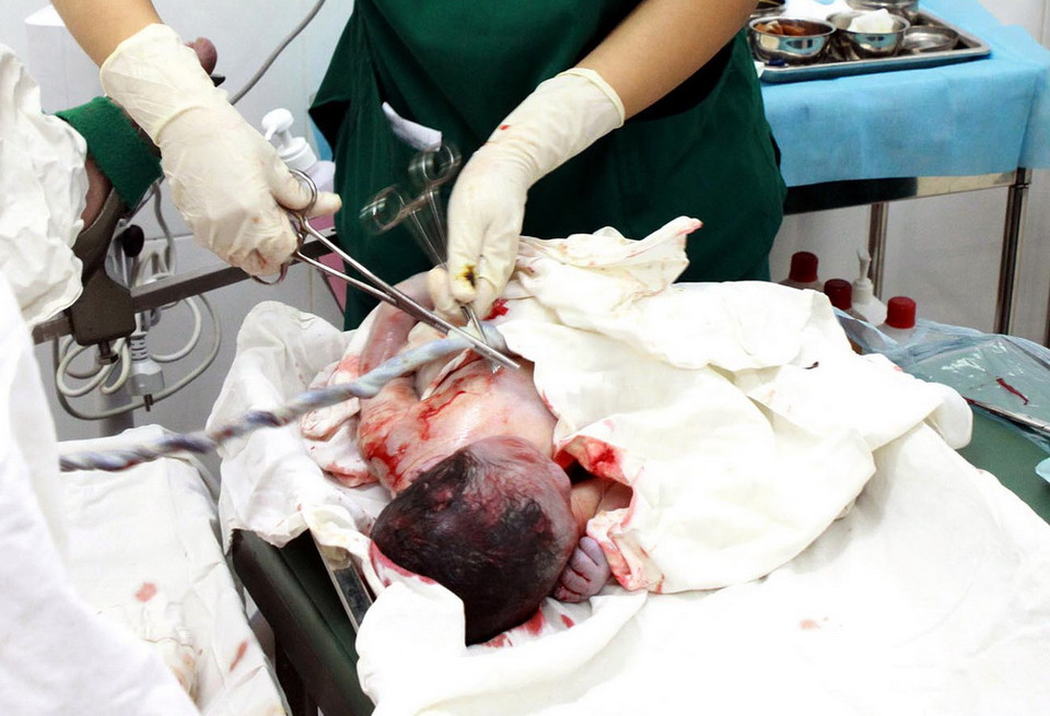 Kỹ thuật lấy máu dây rốn được tiến hành trong vòng 10 phút sau khi sản phụ sinh. Em bé được tách ra khỏi bánh rau và xổ ra khỏi tử cung. Kỹ thuật này không ảnh hưởng tới mẹ và bé. (Ảnh: Dương Ngọc/TTXVN)