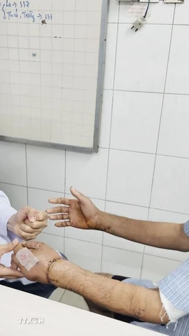 Bác sỹ kiểm tra hai bàn tay được nối thành công của nạn nhân. (Ảnh: TTXVN phát)