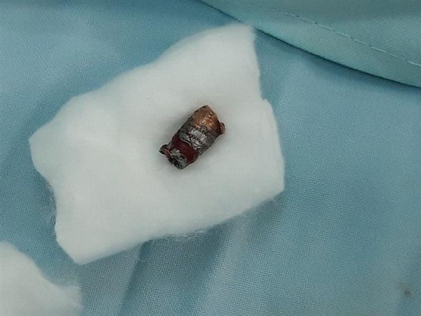 Điều tra vụ dùng súng bút bắn đứt động mạch cổ một thanh niên ảnh 1