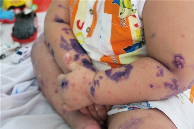 Bệnh tay chân miệng ở người lớn và ở trẻ em khác nhau thế nào? ảnh 1