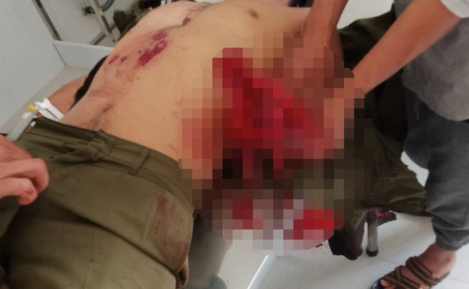 Lâm Đồng: Mìn đánh cá tự chế phát nổ khiến 7 người bị thương ảnh 1