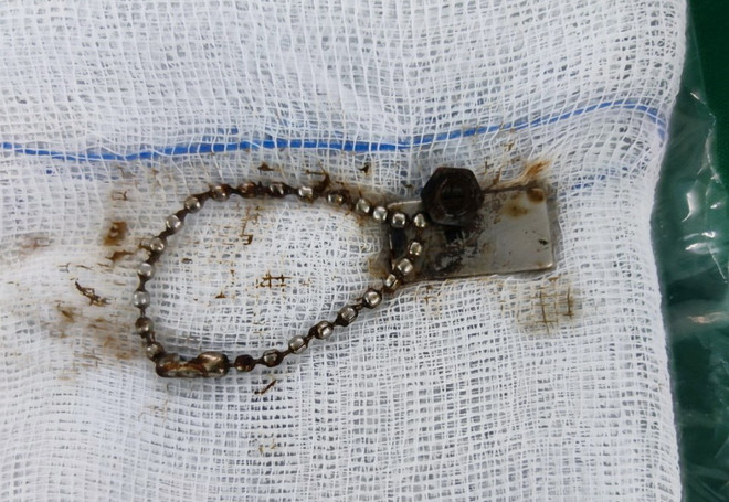 Phẫu thuật cho trẻ nuốt chuỗi hạt kim loại gắn nam châm gây thủng ruột ảnh 1