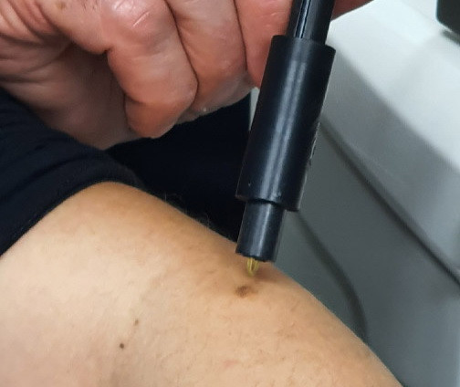 Israel phát triển công nghệ quang học giúp chẩn đoán nhanh ung thư da ảnh 1