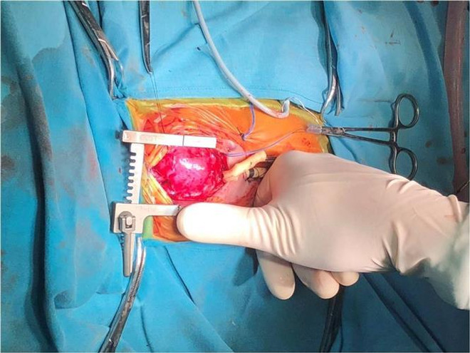 Phẫu thuật tim hở cho bệnh nhi nhẹ cân nhất từ trước đến nay ảnh 2