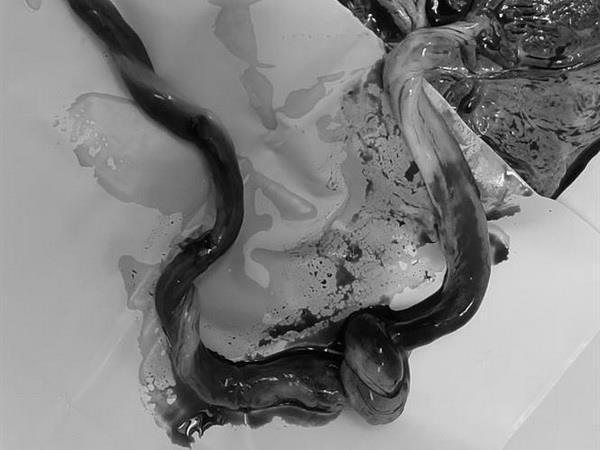 Cấp cứu thành công thai nhi bị dây rốn thắt nút gây tắc mạch ảnh 1