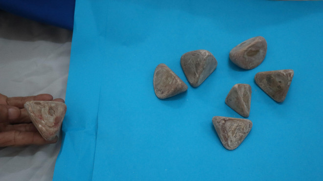 Bàng hoàng phát hiện 7 cục sỏi khổng lồ nặng 0,5kg trong bàng quang ảnh 1