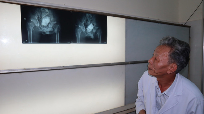 Bàng hoàng phát hiện 7 cục sỏi khổng lồ nặng 0,5kg trong bàng quang ảnh 2