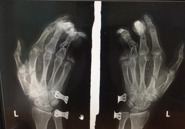 Điện thoại phát nổ khi đang sạc, nam thanh niên bị dập nát bàn tay ảnh 1