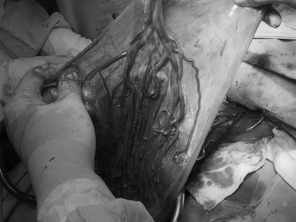 Cần Thơ: Cứu sống thai nhi bị dây rốn bám màng hiếm gặp ảnh 1