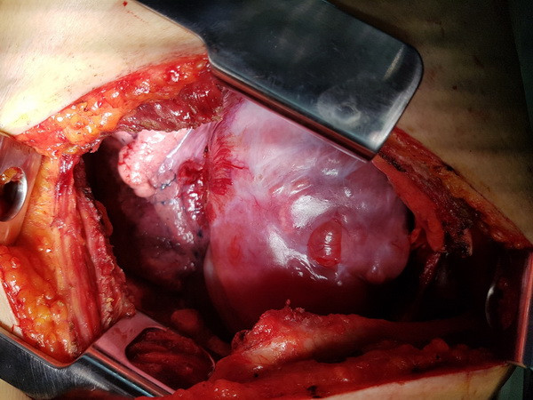 Đà Nẵng: Cứu sống một bệnh nhân bị khối u lớn chèn ép tim phổi ảnh 1