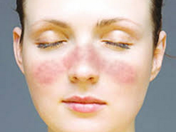 Phát hiện mới về phương pháp chữa trị bệnh phát ban đỏ ảnh 1