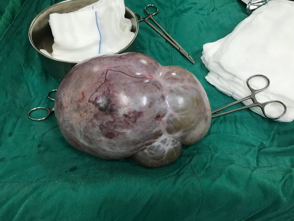 Kon Tum: Bóc tách thành công khối u buồng trứng nặng gần 4kg ảnh 1