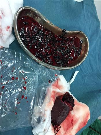 Cần Thơ: Cứu sống kịp thời bệnh nhi bị vỡ lách do tai nạn sinh hoạt ảnh 2